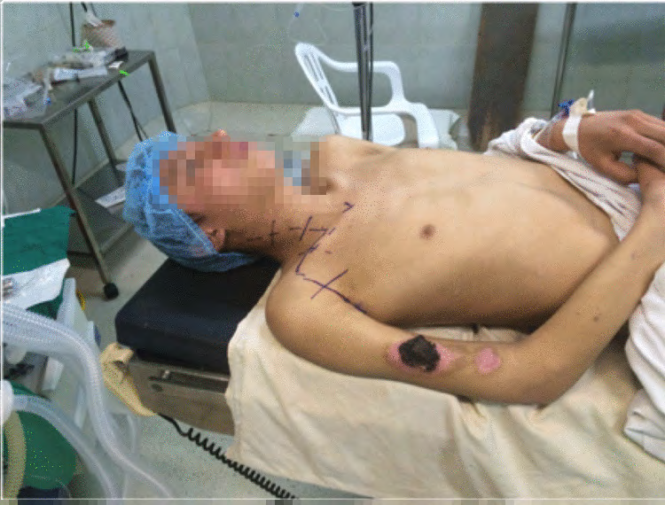 Figure 3: Incision type during cervical approach through the deltopectoral groove.