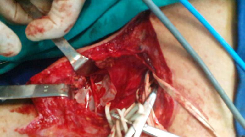 Figure 5: Neurotization of the nerve suprascapular with the spinal nerve. (XI pair).