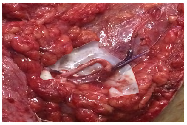 Figure 7: Neurotization of the musculocutaneous nerve with the intercostal nerves.