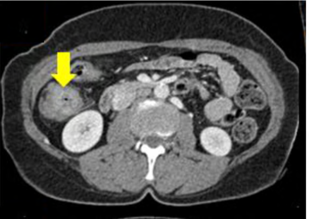 Figure 1: CT scan of the abdomino pelvic area with injection of iodinated contrast showing a circumferential, irregular and asymmetrical parietal thickening of the right colon with eccentric lumen heterogeneously enhanced after injection of iodinated contrast associated with infiltration of the surrounding fat.