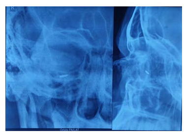Figure 1: OD- Picture post trauma.