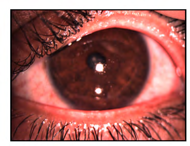 Figure 4: NCCT orbit showing radio-dense IOFB in the inferior aspect of right globe.