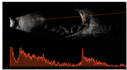Figure 5: Ultrasound B-scan of the right eye showing dot and membranous echoes suggestive of vitreous hemorrhage with high reflective intensity with 100% spike and back shadowing characteristic of RIOFB (approximate size- 7.96mm) with normal RCS thickness.