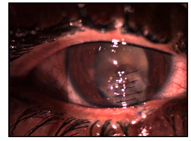 Figure 6: POD-3, image shows intact corneal sutures, AC reaction and ruptured lens capsule with cataractous lens.