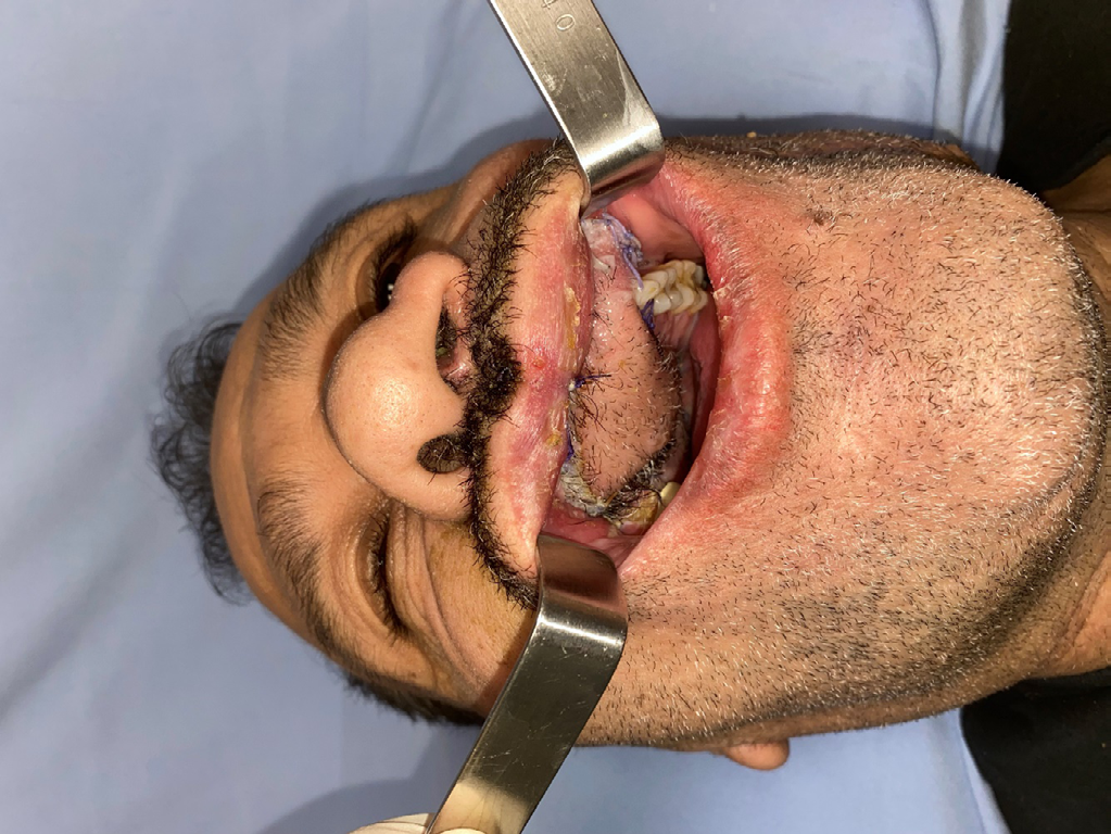 Figure 4: Postoperative 4.th week view of the flap.