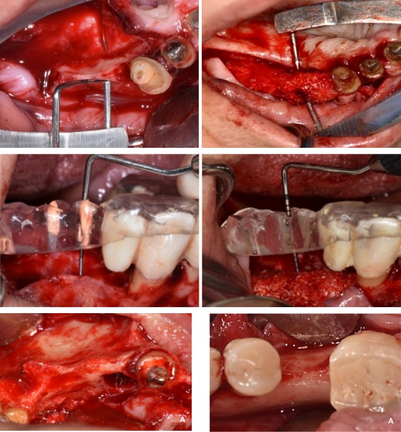 Figure 1: This measure was used during implant placement surgery to locate the vertical position of the pre-operative ridge measurements in case of changes in ridge height. After advancement of the buccal and lingual flaps, the buccal aspect of the crest was decorticated. Using a 0.5 cc spoon, the particulate bone graft consisting of a composite autograft-xenograft was then prepared in a 1:3 ratio mixed in sterile saline. The autograft was obtained by scraping the adjacent bony region with a bone scraper (SafeScraper TWIST, META, Reggio Emilia, and Italy). The xenograft used was a DBBM with a 250-1000 microns particle size (OCS-B Xenomatrix®, Nibec, Chungcheongbuk-do, Korea). After opening the sequentially sealed envelope, the patient was allocated to either CL or NonCL group. The membrane was fixed first on the buccal side with titanium pins (Masetrpin®, Meisinger, Neuss, Germany) in a way to create a pouch like space [22]. Second, the composite graft was applied between the membrane and the crest with a slight over fill. Then the membrane was slightly stretched, wrapped over the ridge, and tightly stabilized palatally/lingually with the titanium pins. Using (4/0) PTFE monofilament sutures (Osteogenics Biomedical, Lubbock, TX, USA), a tight wound closure was achieved by placing a first line of horizontal mattress sutures followed by a second line of combined Laurell-Gottlow sutures and interrupted sutures along the horizontal incision [22]. The vertical releasing incisions were closed with a combination of Laurel-Gottlow sutures and interrupted sutures [22]. All patients were prescribed 0.12% CHX mouthwash (twice daily for 2 weeks), NSAIDs drugs (Bruffen 400 mg every 6 hours, Abbott Laboratories, Illinois, CHI, USA) and/ or paracetamol-opioid analgesics (Solpadeine, Omega Pharma Nazareth, Belgium). An extraoral cold pressure dressing was applied. Sutures were removed 3 weeks after surgery. During the first week after surgery, a CBCT of the operated region was performed, with the Stent in place. Follow-up visits were performed at 1, 2, 4, 8, 12, 16, 20 and 24 weeks post-surgery.