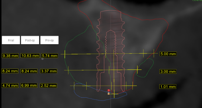 Figure 10: Histomorphometry measurements in each group. CL: glutaraldehyde cross-linked collagen membrane. NonCL: Non-cross-linked collagen membrane [30].