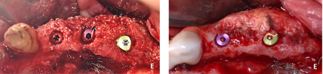 Figure 4: ** The CBCTs and the volumetric reconstructions of the DICOM files at pre-op. **A:** post op, **B:** implant placement surgery, **C:** for the CL group. The red volume represented the volume of the recipient bed before surgery. The green volume represented the volume of the graft at re-entry. The blue volume represented the volume of graft resorption between bone regeneration surgery and re-entry. The yellow volume represented the volume of the resorbed pristine bone after surgery [27].