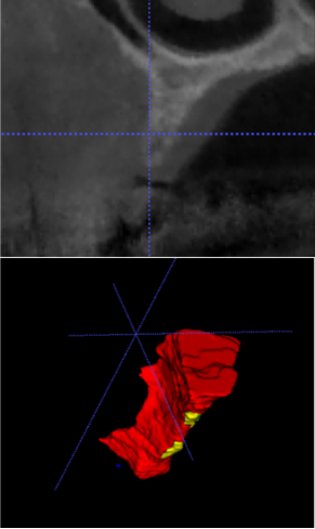 Figure 5: ** The CBCTs and the volumetric reconstructions of the DICOM files at pre-op. **A:** post op **B:** and implant placement surgery **C:** for the NonCL group. The red volume represented the volume of the recipient bed before surgery. The green volume represented the volume of the graft at re-entry. The blue volume represented the volume of graft resorption between bone regeneration surgery and re-entry. The yellow volume represented the volume of the resorbed pristine bone after surgery [27].