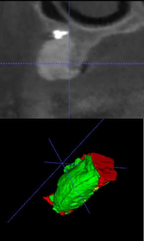 Figure 7: RW measurements at 1, 3 and 5mm from the RC in the CL group. Red outline: recipient bed outline before surgery. Green outline: The graft outline at re-entry. Blue outline: outline of the resorbed graft during healing. The combined outline of the blue and green outline represents the surface of the created graft immediately after the regeneration surgery [28].