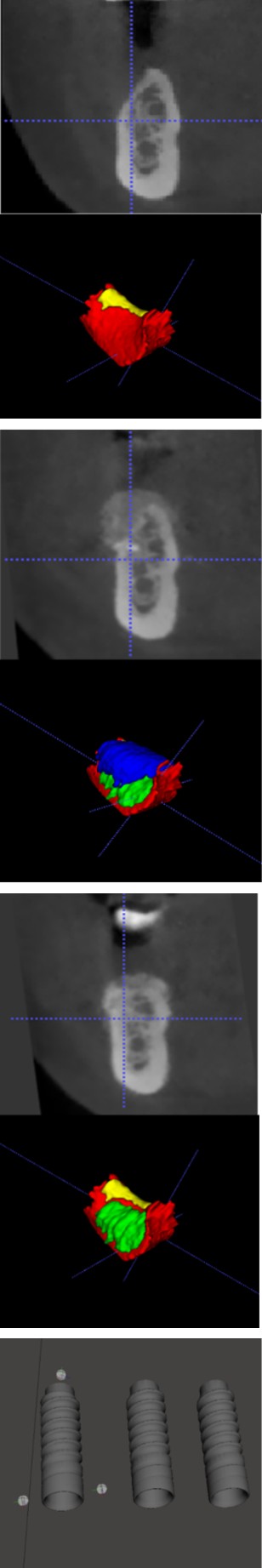 Figure 8: RW measurements at 1, 3 and 5mm from RC in the NonCL group. Red outline: recipient bed outline before surgery. Green outline: The graft outline at re-entry. Blue outline: outline of the resorbed graft during healing. The combined outline of the blue and green outline represents the surface of the created graft immediately after the regeneration surgery [29].
