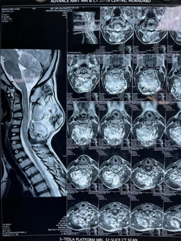 Figure 3: Whole-spine magnetic resonance imaging revealed a large heterogenous lesion of size 10.7 × 5.2 × 7.3 cm involving posterior elements of the C1–C6 vertebra with no obvious intradural extension or involvement of paraspinal muscles.