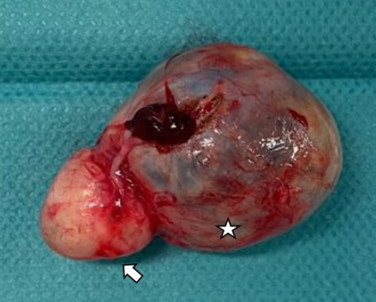 Figure 3: Macroscopic aspect of the mature teratoma (star) and epidermoid cyst (arrow).