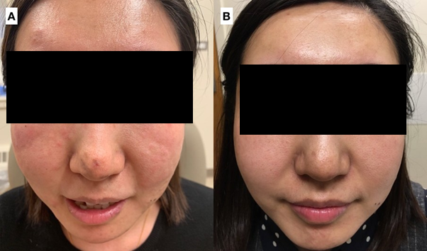 Figure 1: (A) Pretreatment with scattered erythematous papules on face. (B) Resolution of lesions following 6 months treatment of isotretinoin.