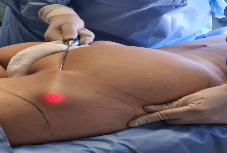 Figure 1: Shows the Lipo one STEP HD being Performed.