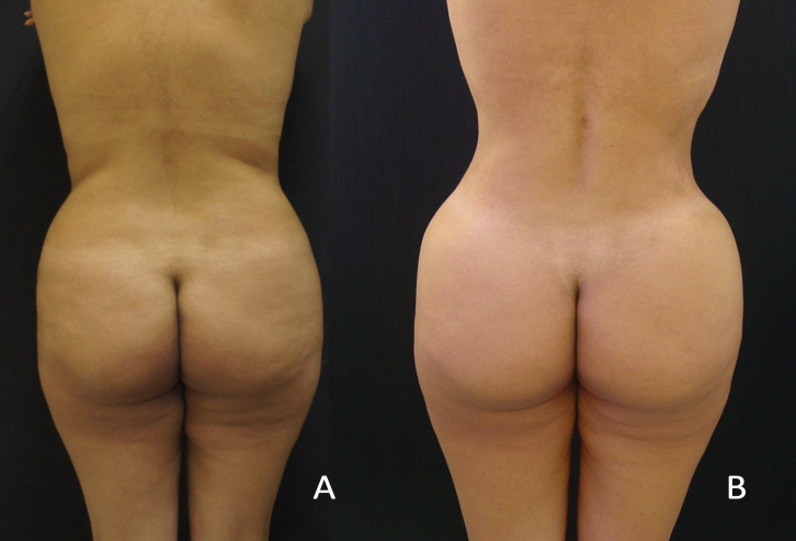 Figure 2: Shows A 3-Month Follow-up (A- Before; B- After the Surgery).