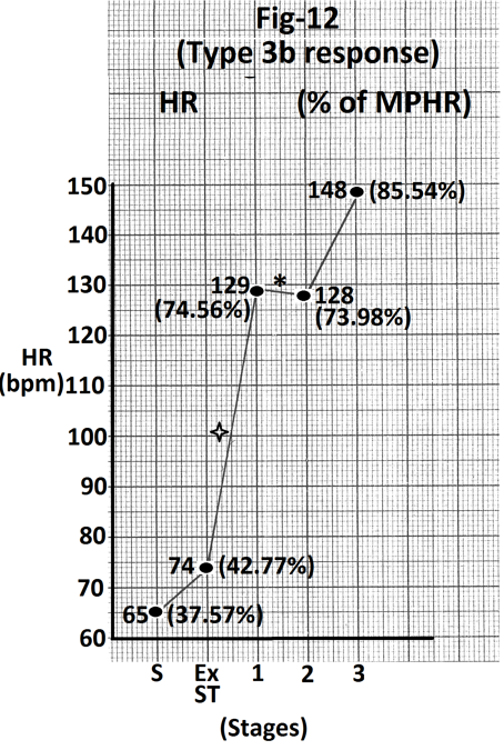 Figure 12: Graph of heart rate at the end of different stages of exercise of the person whose treadmill stress test report is shown in Figure 11. There is no increase in heart rate during stage 2 (marked).There is significant increase (55 beats per minute) in heart rate during stage 1 (marked). Abbreviations- HR- heart rate, bpm- beats per minute, S- Supine, Ex ST - Exercise start, ST - Stage of stress, MPHR- percentage of age predicted maximal heart rate.