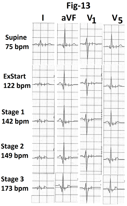 Figure 13: Part of the average page of treadmill stress test report from another person with type 3b response showing minimal increase in heart rate during stage 2. There is no evidence of exercise induced ischemia in leads I, aVF, V1 and V5.