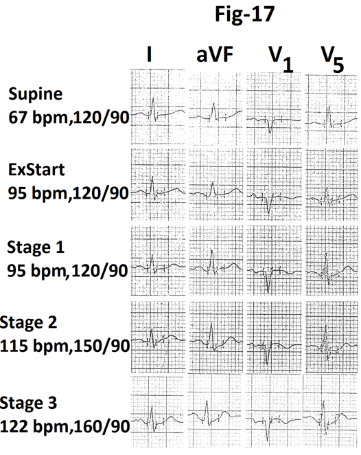 Figure 17: Representative tracings of leads I, aVF, V1 and V5 are also shown in Figure 17. There is no evidence of exercise induced myocardial ischemia. Graph showing heart rate and percentage of MPHR attained at the end of different stages of stress from the same person are shown in Figure 18. There is minimal increase in heart rate (9 bpm) during stage 3(marked).