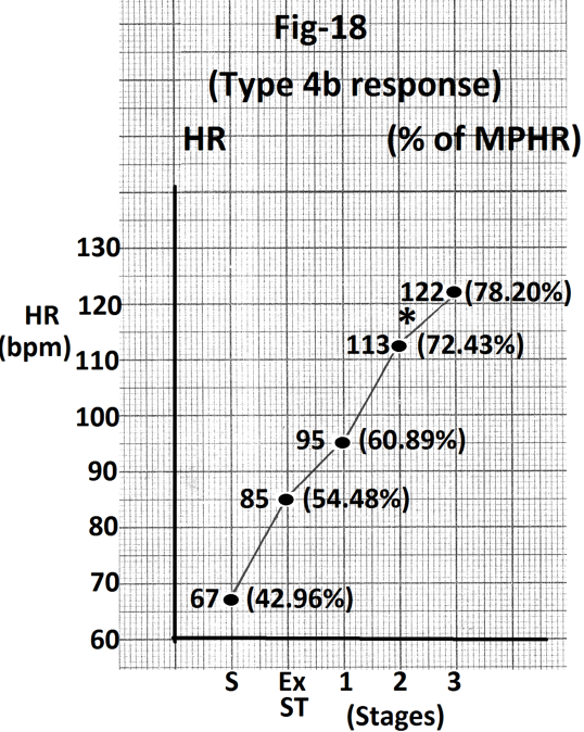 Figure 18: Graph of heart rate at the end of different stages of exercise of the person whose treadmill stress test report is shown in Figure 17. There is minimal increase in heart rate (9 beats per minute) during stage 3(marked). Abbreviations- HR- heart rate, bpm- beats per minute, S- Supine, Ex ST - Exercise start, ST - Stage of stress, MPHR- percentage of age predicted maximal heart rate.