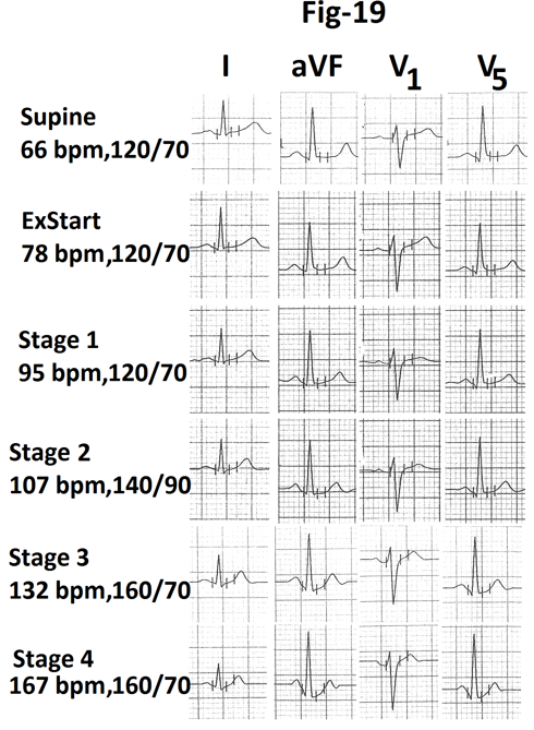 Figure 19: Representative tracings of leads I, aVF, V1 and V5 are also shown in Figure 19. There is no evidence of exercise induced myocardial ischemia. Graph showing heart rate and percentage of MPHR attained at the end of different staged of stress from the same case are shown in Figure 20. Maximum increase in heart rate (35 bpm) is seen during stage 4(marked).