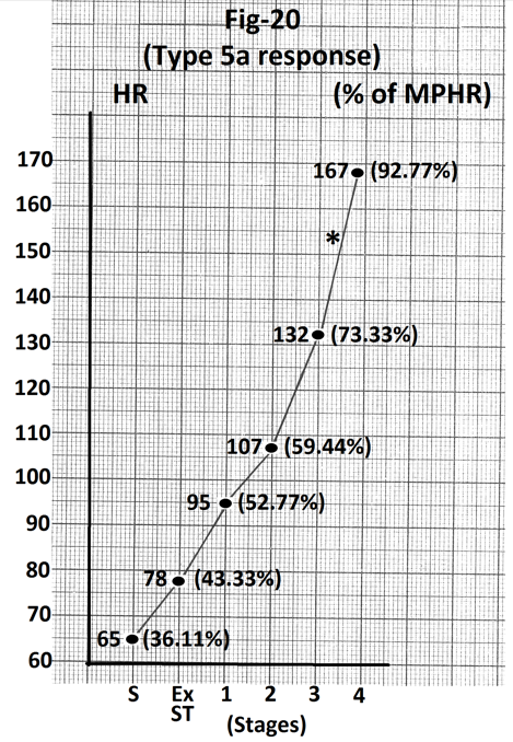 Figure 20: Graph of heart rate at the end of different stages of exercise of the person whose treadmill stress test report is shown in Figure 19. There is maximal increase in heart rate (35 beats per minute) during stage 4(marked). There is relatively less increase in heart rate up to end of stage 2. Abbreviations- HR- heart rate, bpm- beats per minute, S- Supine, Ex ST - Exercise start, ST - Stage of stress, MPHR- percentage of age predicted maximal heart rate.
