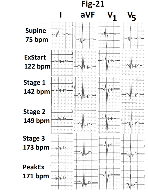 Figure 21: Representative tracings of leads I, aVF, V1 and V5 are also shown. There is no evidence of exercise induced myocardial ischemia. Graph showing heart rate and percentage of MPHR attained at the end of different stages of stress and during stage 4 from the same case are shown in Figure 22. There is decrease of 2 bpm during stage 4(marked).