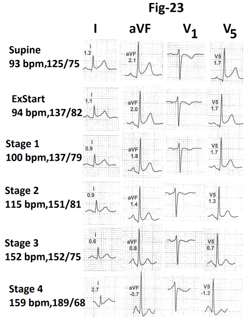 Figure 23: Tracings of treadmill stress test report of the person who could complete stage 5 of Bruce protocol. There is no evidence of exercise induced ischemia in leads I, aVF, V1 and V5.