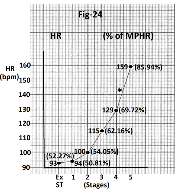 Figure 24: Graph of heart rate response of the person who could complete stage 5. Maximum increase in heart rate (30 bpm) occurred in stage 5 (marked). Abbreviations- HR- heart rate, bpm- beats per minute, S- Supine, Ex ST - Exercise start, ST - Stage of stress, MPHR- percentage of age predicted maximal heart rate.