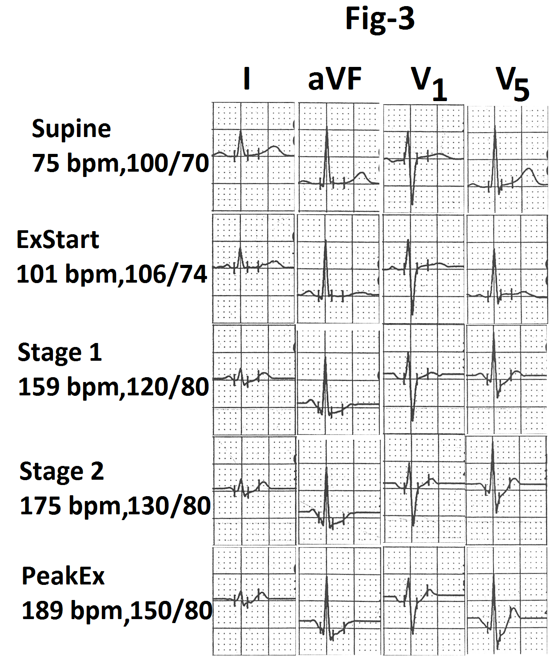 Figure 3: Representative tracings of leads I, aVF, V1 and V5 are also shown in Figure 3.