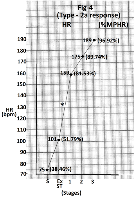 Figure 4: There is significant increase in heart rate (88 beats per minute) during stage 1(marked).