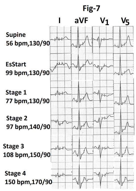 Figure 7: Representative tracings of leads I, aVF, V1 and V5 are also shown in figure 7. There is no evidence of exercise induced myocardial ischemia. Graph showing heart rate and percentage of MPHR attained at the end of different stages from the same person is shown in Figure 8. There is decrease in heart rate (22bpm) during stage 1(marked). There is significant increase in heart rate (43bpm) from supine to start of exercise (marked). There is significant increase in heart rate (42 bpm) again during stage 4 (marked).
