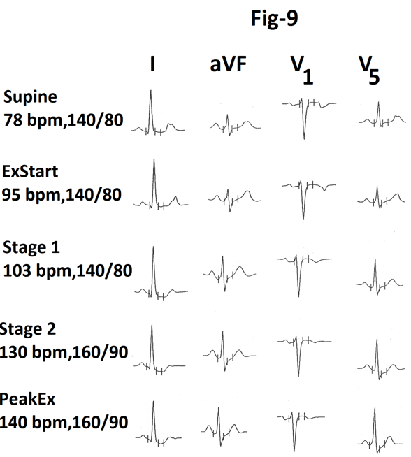 Figure 9: Representative tracings of leads I, aVF, V1 and V5 are also shown in Figure 9. There is no evidence of exercise induced myocardial ischemia. Graph showing heart rate and percentage of MPHR attained at the end of different stages from same person is shown in Figure 10. There is significant increase (27 bpm) in heart rate during stage 2(marked).