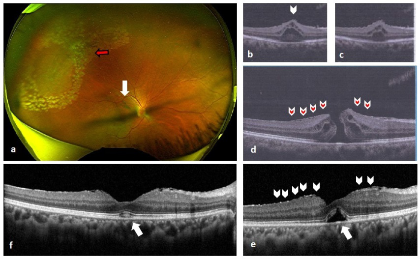 Figure 1: a) Wide field colour fundus photo of right eye showing lasered lattice degeneration in superior temporal quadrant (red arrow) with presence of Weiss ring (white arrow). b,c) OCT showing retinal elevation of posterior vitreous attachment. d) OCT showing FTMH with continuous ILM (red arrow heads). e) SD-OCT on day of surgery showing closure of FTMH with multiple micro-breaks in ILM (white arrow-heads) and presence of outer retinal defect (white arrow). f) SD-OCT showing FTMH closure with complete resolution of ORD and regeneration of outer retinal photoreceptor in fovea (white arrow).