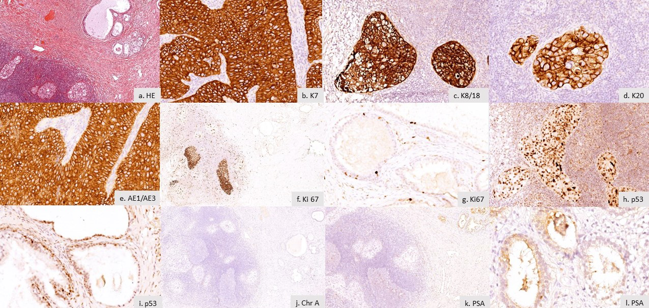 Figure 1: The molecular profile of the urothelial carcinoma of the prostate. a) HE staining, x 10 magnification. b) Immunoexpression of keratin 7 in the tumor area, x 40 magnification. c) Positivity of keratin 8/18 in the tumor area, x 20 magnification. d) Keratin 20 positive tumor cells, x 40 magnification. e) Immunoexpression of keratin AE1/AE3 in tumor cells, x 40 magnification. f) Ki 67 Immunoexpression in more than 80% of tumor cells, x10 magnification. g) Ki67 expression in the basal cells of the normal prostate glandular epithelium.h) p53 nuclear expression in the tumor cells, x 40 magnification. i) p53 positivity in the basal cells of the normal prostate glandular epithelium, x 40 magification. j) Negative reaction of chromogranine A in the tumor cells, x10 magnification. k) Absence of PSA expression in tumor cells, x 10 magnification. l) PSA Immunoexpression, in principal cells of the prostate glandular epithelium, x 40 magnification.