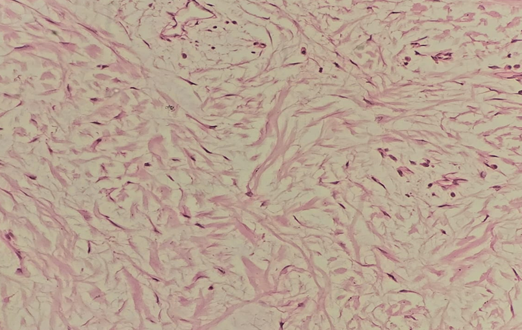 Figure 5: Microscopy of the tumour showing mature fibrous connective tissue and the connective tissue stroma shows loosely arranged fascicles of bland spindle to stellate cells.
