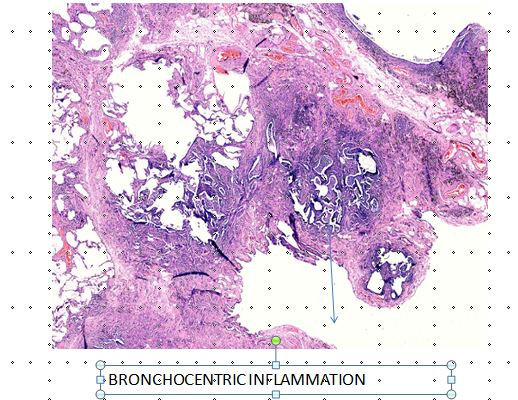 Figure 1: Low power H&E stained slide showing broncho- centric inflammation (arrow).