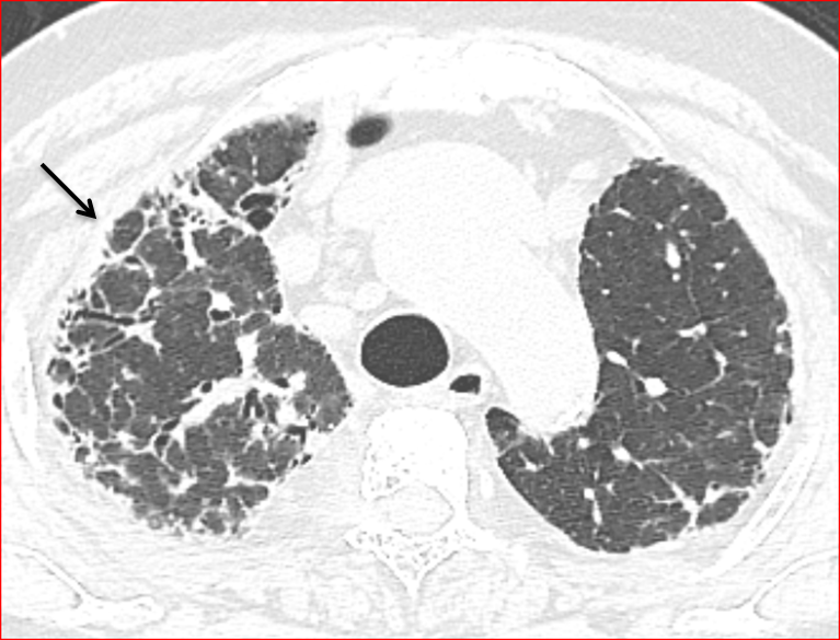 Figure 10: HRCT scan showing asymmetric peribronchial and peripheral interstitial fibrosis in the right upper lobe with traction bronchiectasis. The left upper lobe shows only peripheral fibrosis.