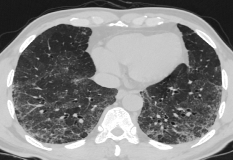 Figure 18: Axial scan showing a cyst (arrow) in the left lower lobe.