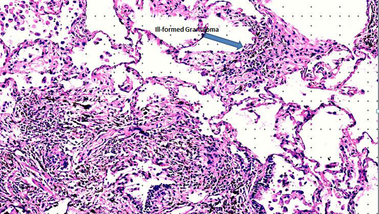 Figure 2: High power H& E stained image showing ill-formed granuloma (arrow).