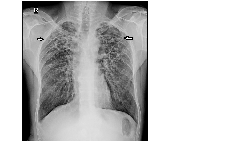 Figure 4: Chest X-ray showing bilateral upper lobe fibrosis (arrows).