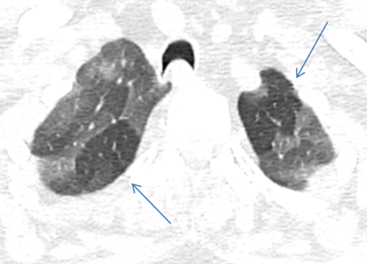 Figure 5: US of the chest showing B lines in the lung bases (arrow).