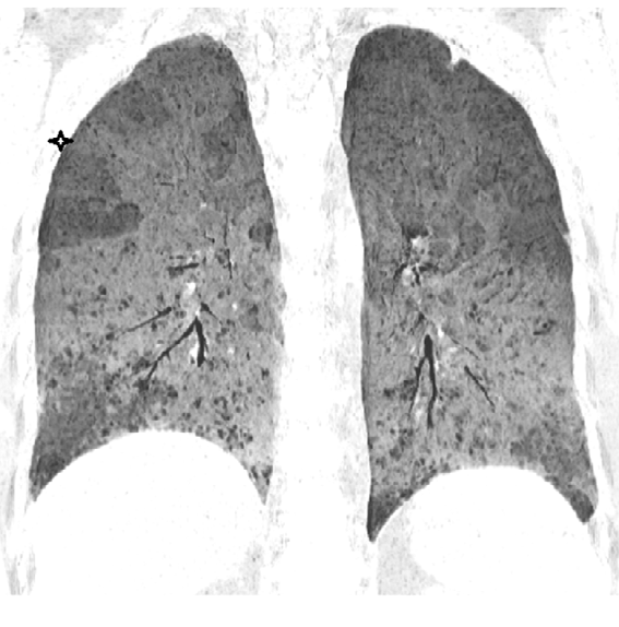 Figure 8: MINIP sequence showing air trapping in the right upper lobe (asterisk) and multiple small bilateral cystic spaces.