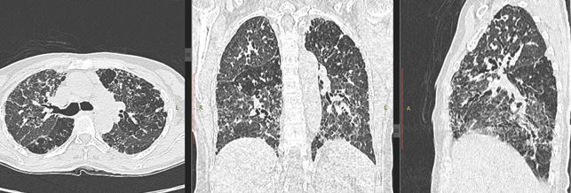 Figure 9: Value of multiplanar reconstructions: Axial, coronal and sagittal images show upper lobe, central to peripheral and anterior to posterior extent of the fibrosis.