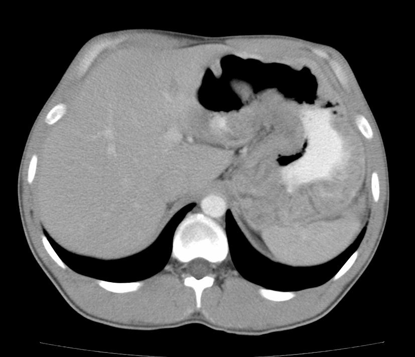 Figure 1: Contrast-enhanced abdominal CT exam demonstrating giant gastric folds involving the entire stomach.