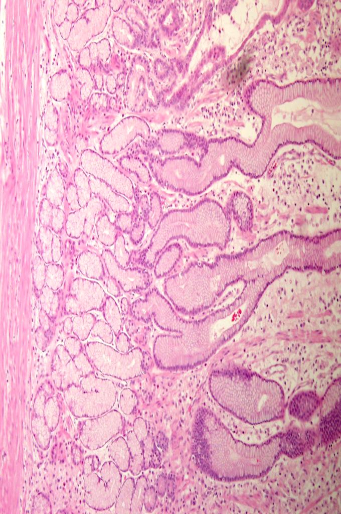Figure 2: The microscopic findings showed elongated foveolar epithelium with foveolar mucous cell hyperplasia and cystic dilation of the foveolar glands with neutrophil infiltration confined to the muscularis propria. The pathologic diagnosis was Ménétrier disease.