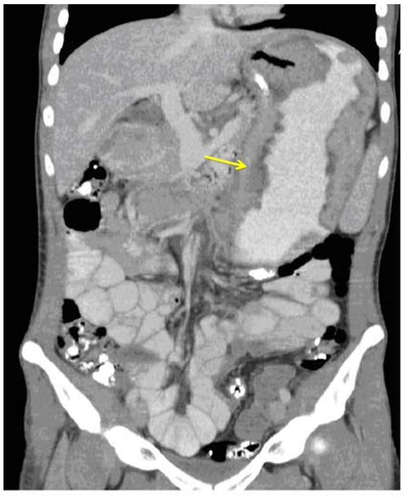 Figure 3: Contrast-enhanced abdominal CT showed marked diffuse thickening of the stomach rugae distributed mainly over the greater and lesser curvatures of the stomach.