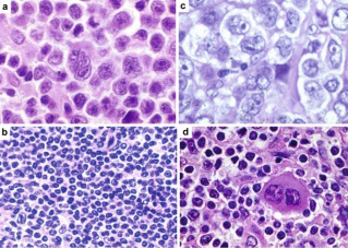 Figure 2: Adult T cell leukaemia/lymphoma delineating neoplastic lymphocytes incorporated with minimal cytoplasm, condensed nuclear chromatin and miniature nucleoli. Occasional bi-lobed nuclei may be observed.