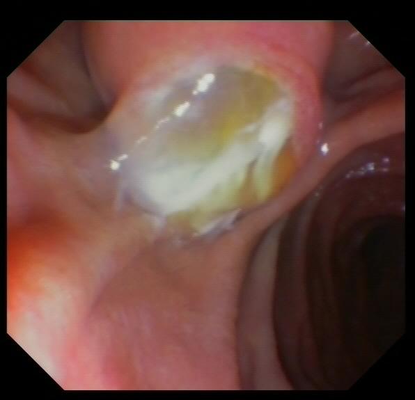 Figure 3: PTC in the common hepatic duct revealing obliteration of the SEMS before clearance and acetylcysteine treatment.