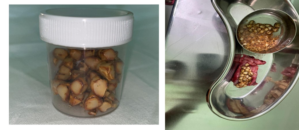 Figure 4: The gall bladder and the stones.